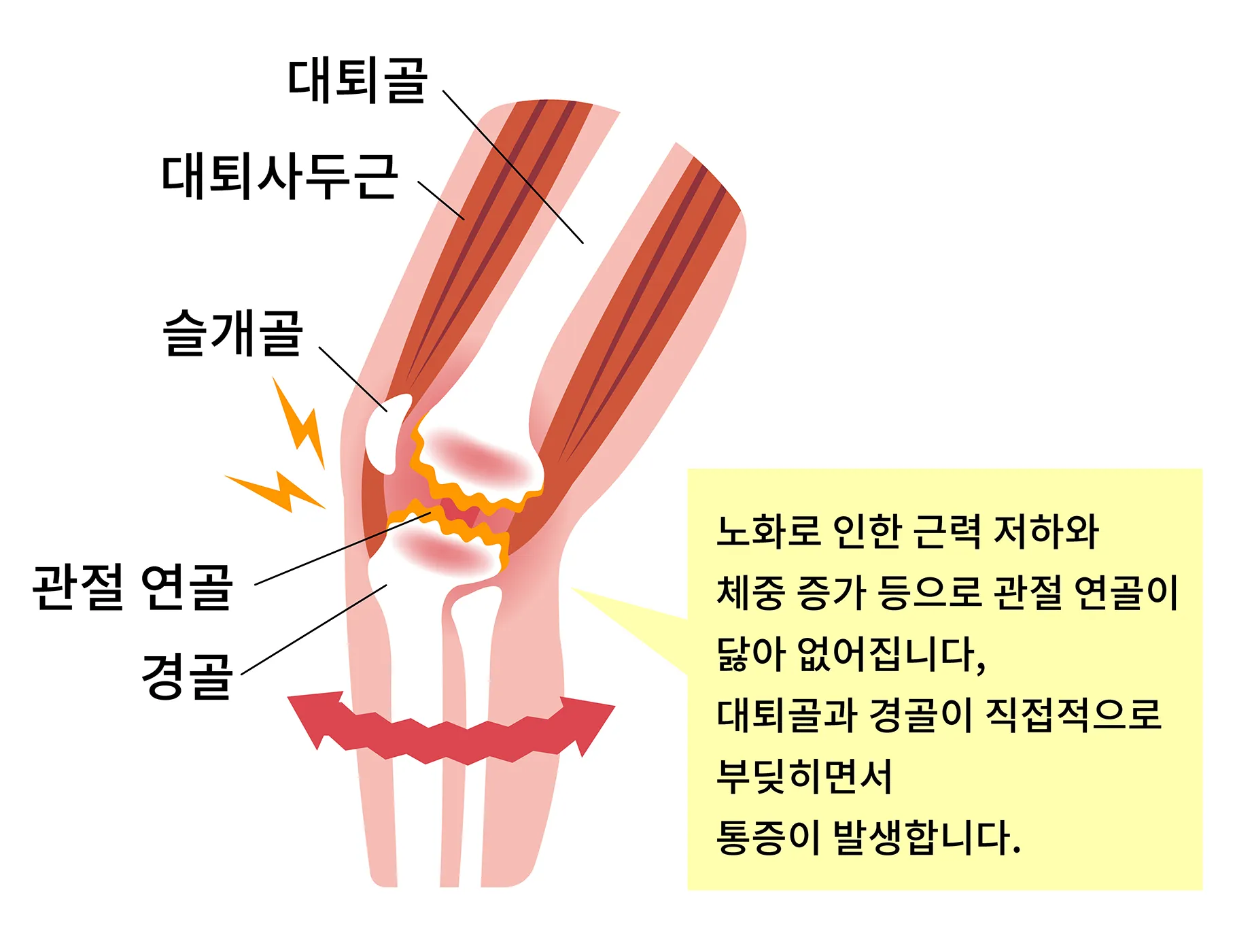 무릎 관절통 골관절염발생 메커니즘과 원인 일러스트