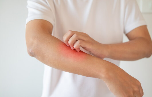 건선-증상-피부가-붉어지는-증상과-부풀어오르는-증상