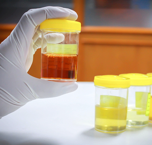 소변 색깔이 노란색