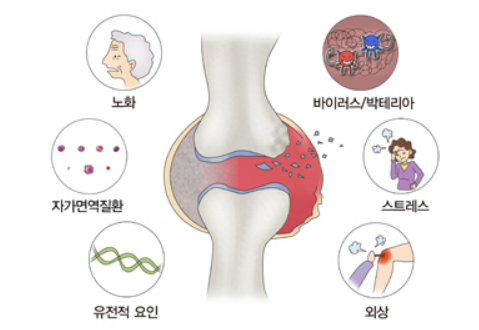 관절염