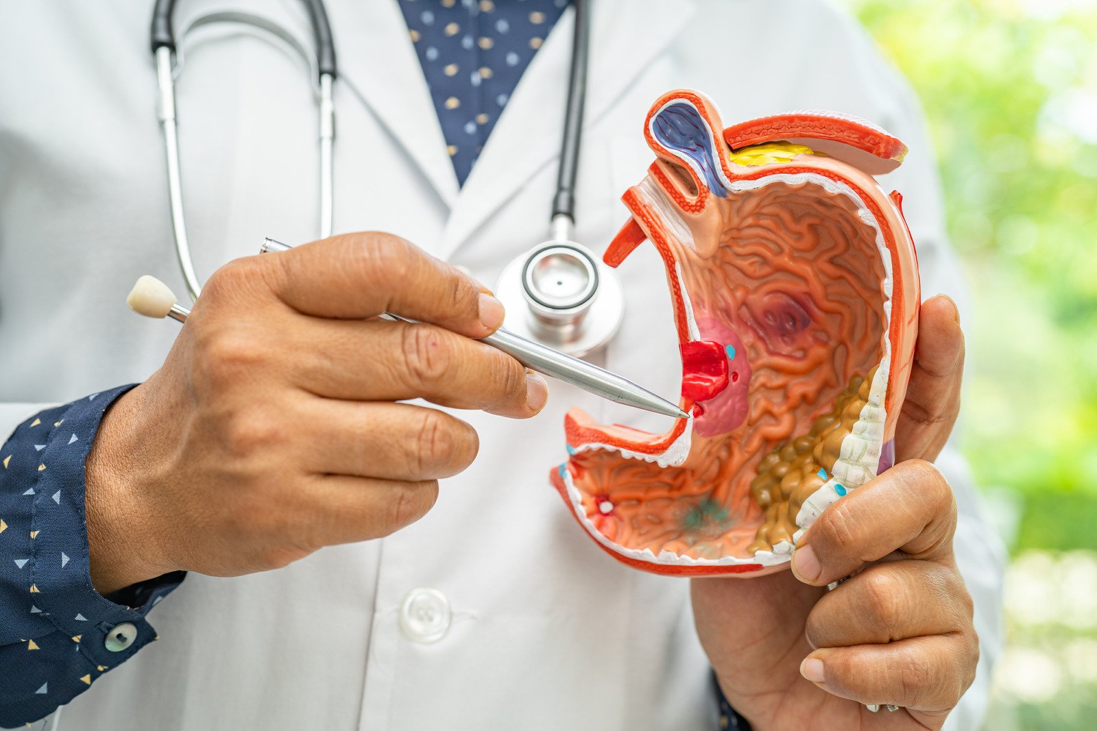 위궤양(Gastric Ulcer): 원인, 증상, 치료 및 예방