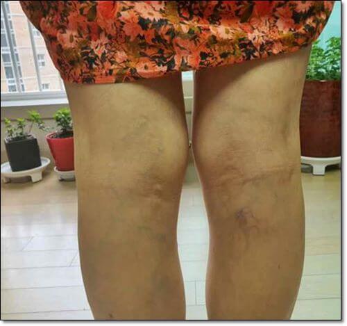 하지정맥류 초기 증상