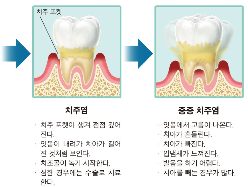 치주질환의 부주의시 악화되는 병세-02