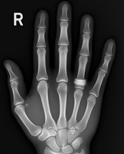 방아쇠 수지 증후군 치료법