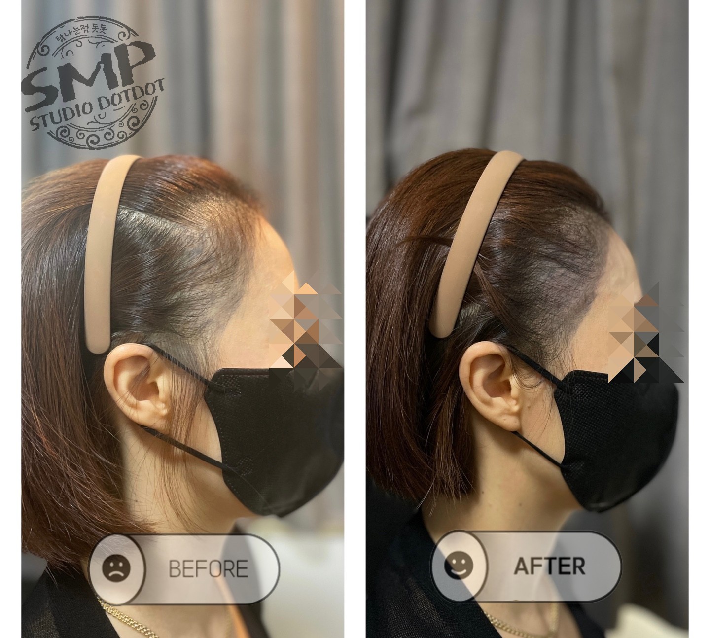 여자-SMP-두피문신