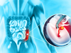 대장내시경 전 음식주의사항