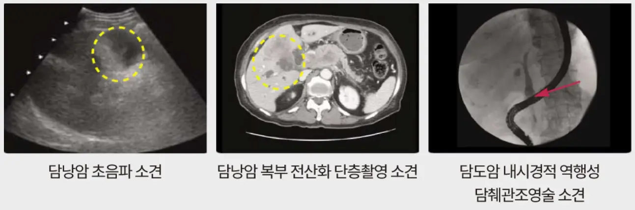 담도암-진단법