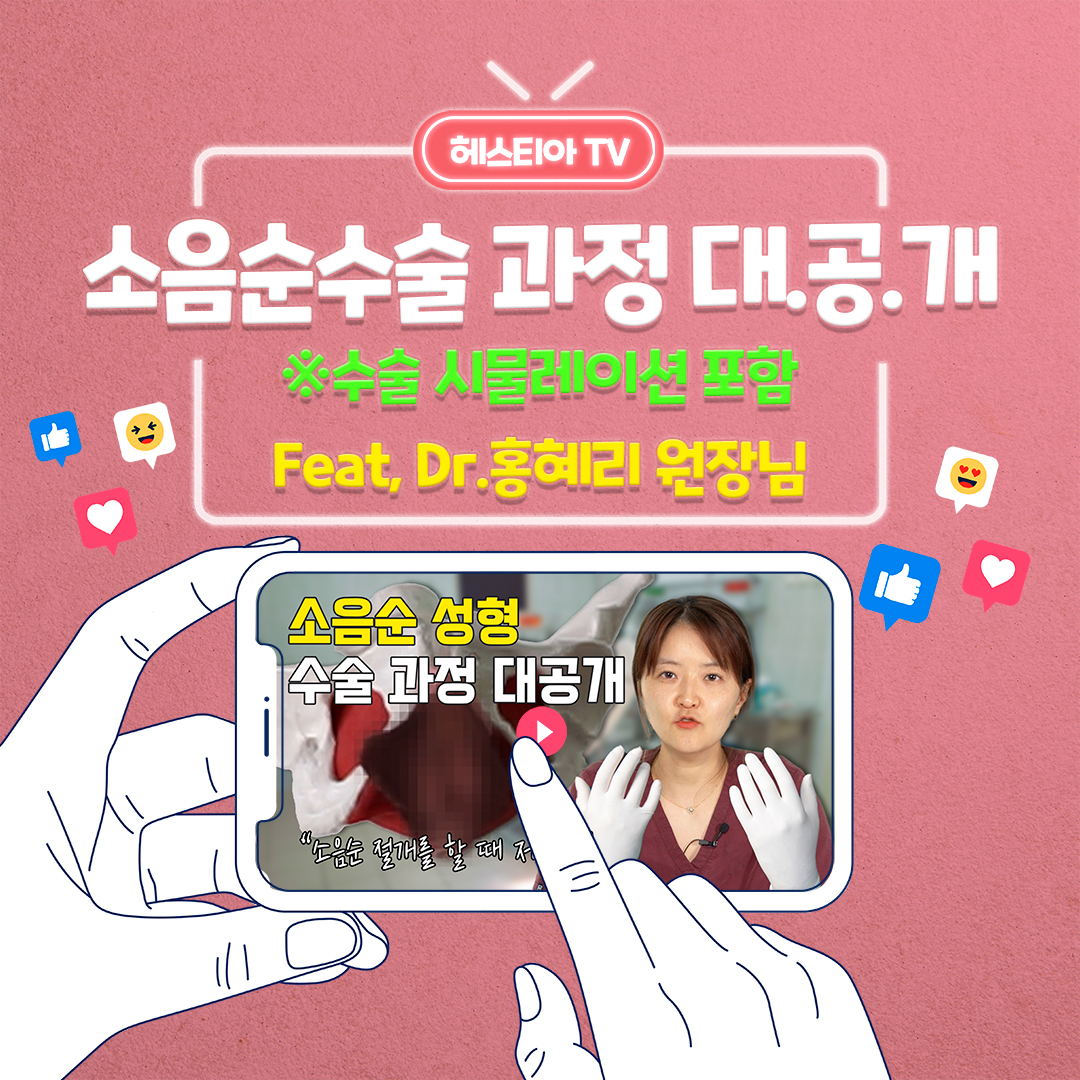 소음순성형수술 과정 대.공.개 ※수술 시물레이션 포함!