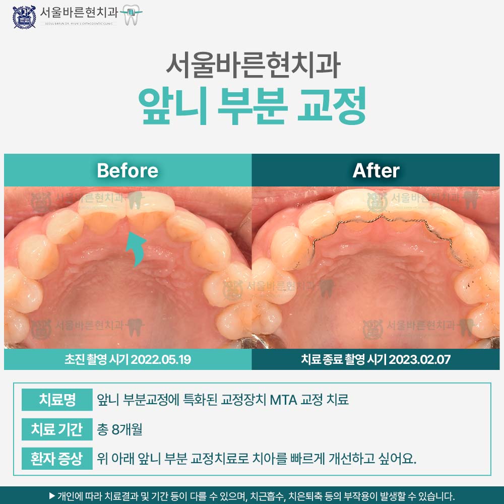 부산치아교정