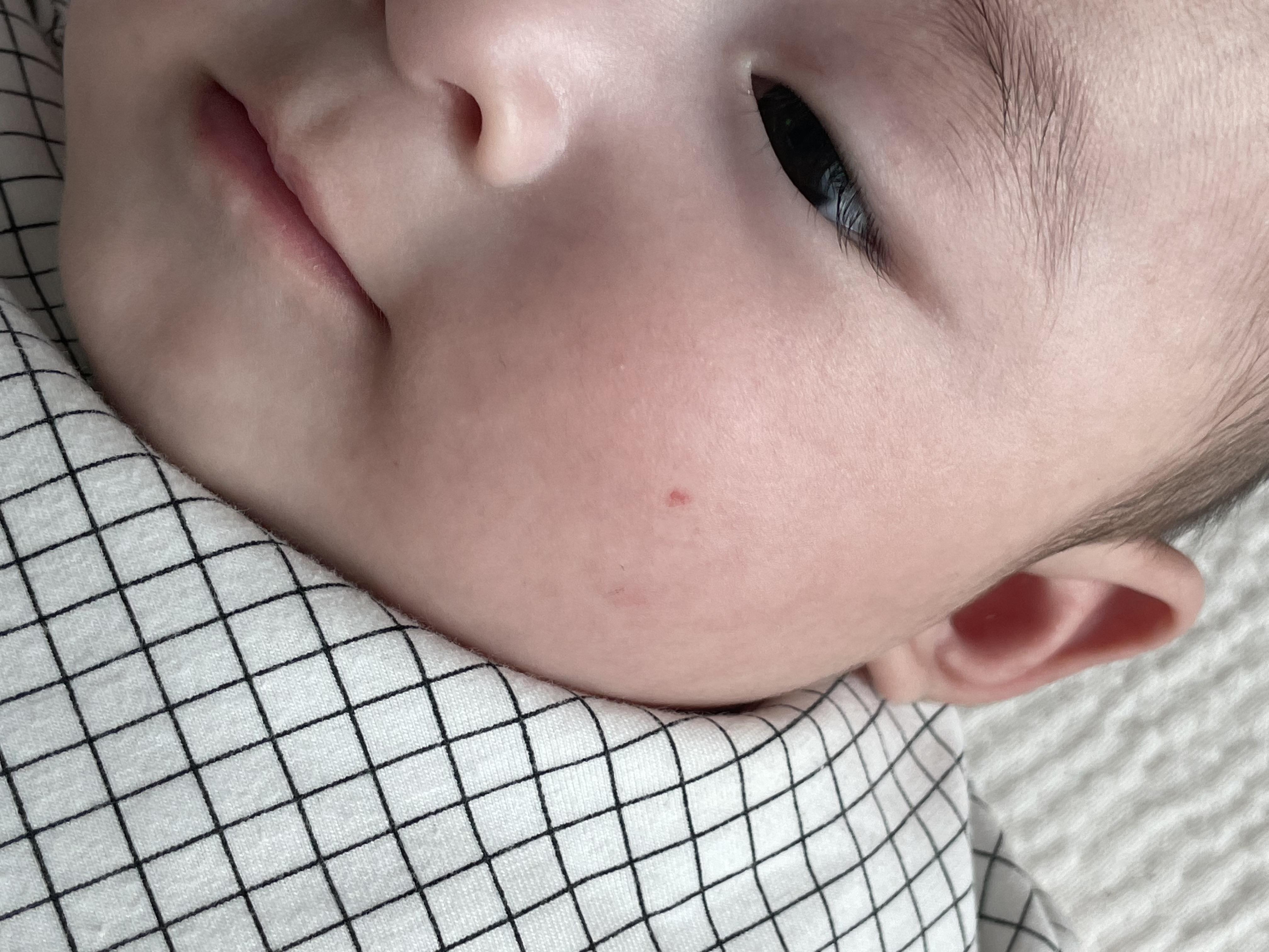 혈관종 에스앤유 피부과