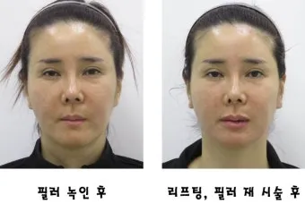 덴서티 리프팅 댄서티 가격 효과 유지기간에 관한 정보_9