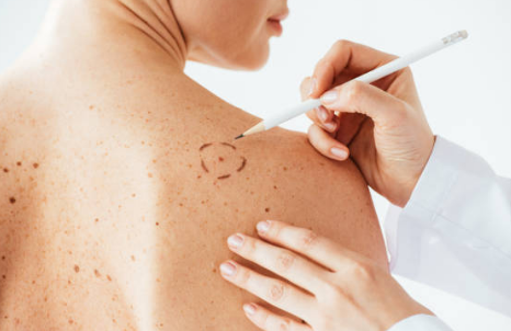 쥐젖 제거방법, 쥐젖이 생기는 이유, 제거 연고 총정리 (2024ver)