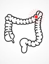대장암 초기증상