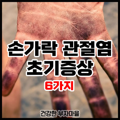손가락 관절염 초기증상