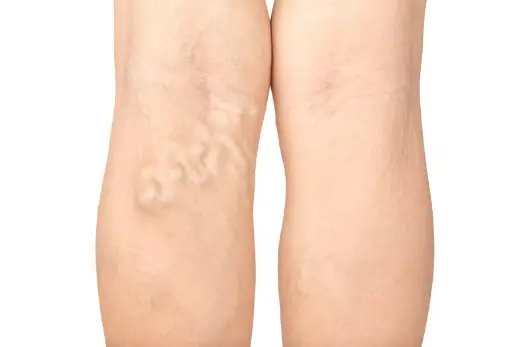 하지정맥류 초기 증상과 원인 치료방법