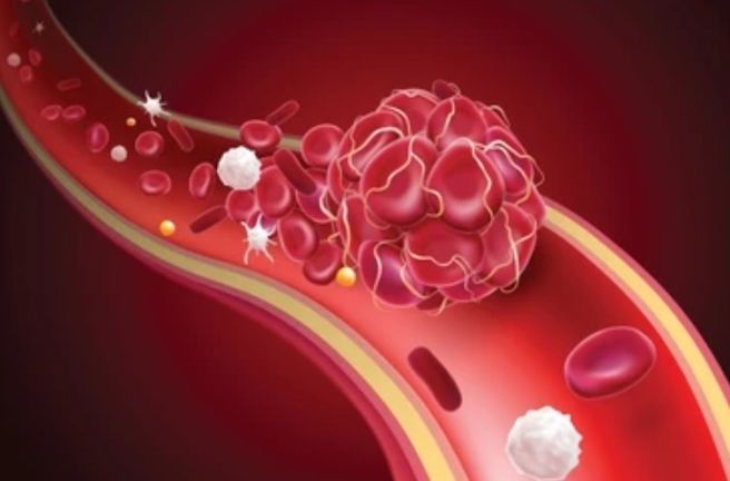 triglycerides 정상 수치