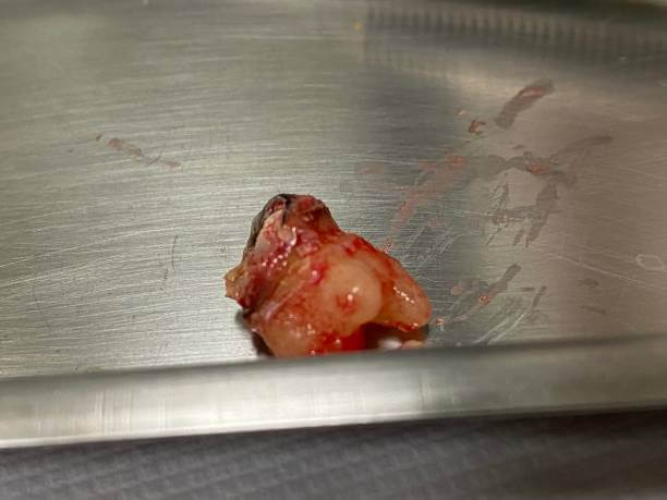 사랑니 발치 후 식사, 드라이 소켓이 생기는 이유에 대해 알아봤습니다. 사랑니 위치와 발치를 한 후에 조심해야 할 사항들, 사랑니를 발치하지 않으면 생기는 질병까지 꼼꼼히 읽어 보시기 바랍니다.