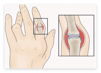 콘드로이친 효능