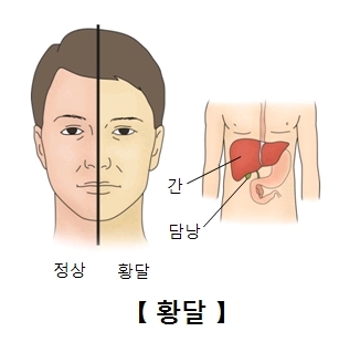 alt="황달"