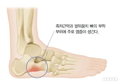 족저근막염 증상 원인 치료방법