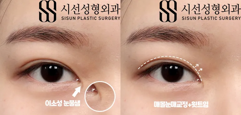 눈물샘 뚫는 수술 간단한가요에 대한 수술정보_3