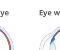 녹내장 초기 증상 &mdash; 시야를 서서히 빼앗는 침묵의 질환