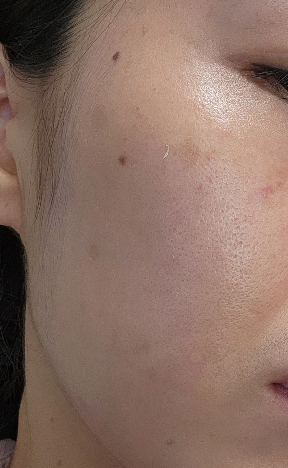 흑자치료 루비레이저 하기전 사진 좌