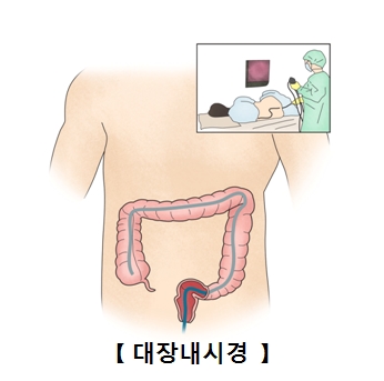 대장내시경 이미지