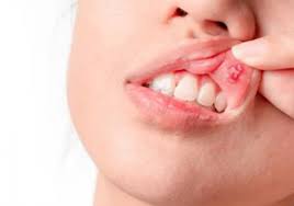 혓바늘 없애는 방법