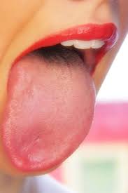 혓바늘 없애는 방법