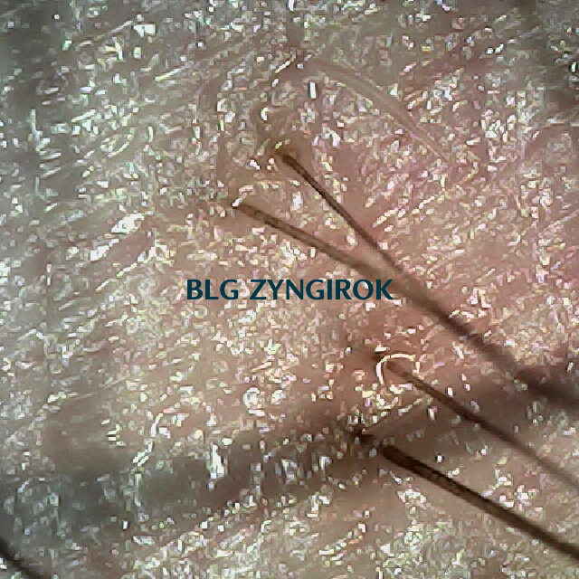 탈모 극복 프로젝트 - 오른쪽 M자 부위 두피 모습이다.