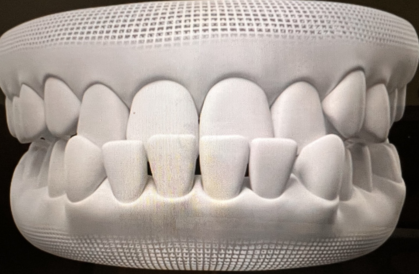 인비절라인 케이스, 반대교합으로 아랫니가 앞니를 덮고 있다