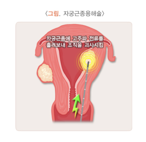 자궁근종용해술