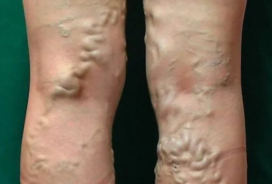 하지 정맥류 증상 치료방법과 예방 생활습관_2