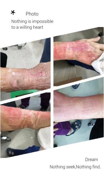 2도 화상 증상 자가치료 회복기간 응급처치법 정리_9