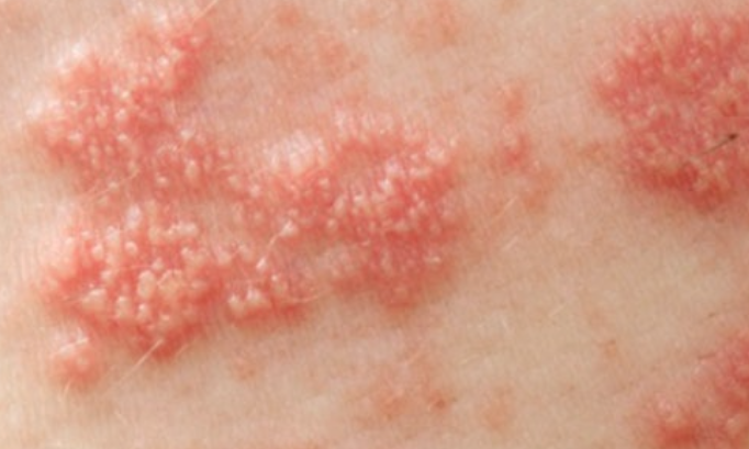 대상포진-초기증상-피부