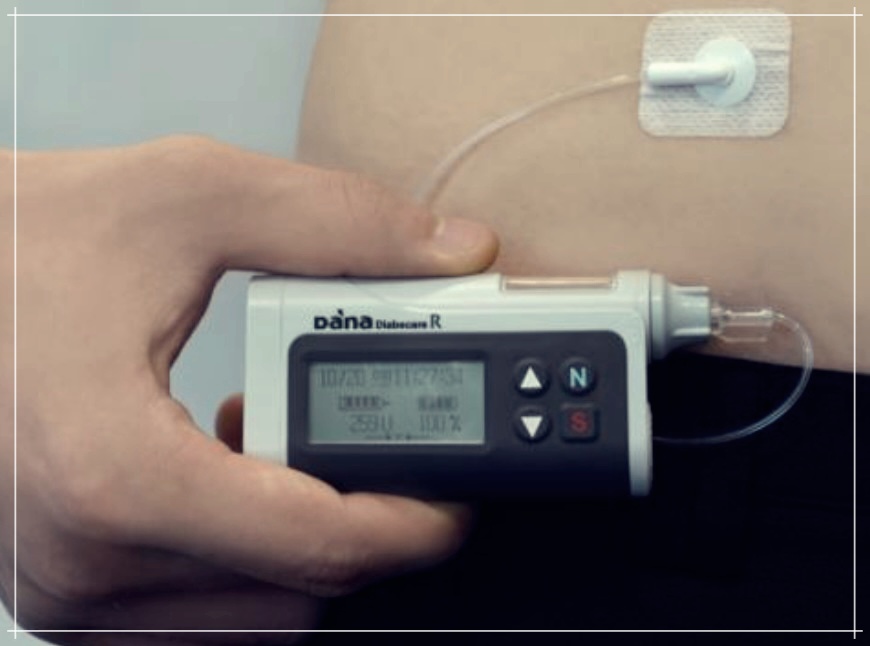 인슐린 펌프: 가격, 종류 및 시술 병원