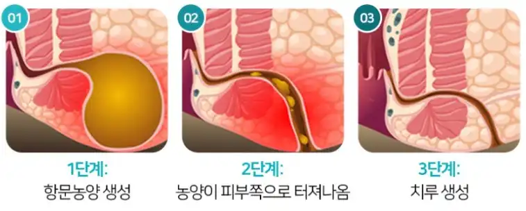 치루증상