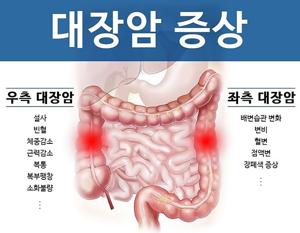 대장암 증상