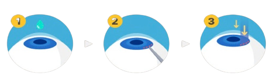 스마일라식 가격 회복기간 부작용 비용 각막두께 통증 : 1분 요약(+2024)