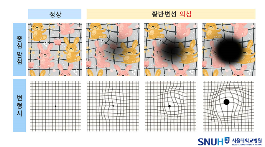 황반병성 자가진단 결과 (출처: 서울대학교 병원)