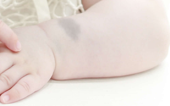 아기 몽고반점, 몽고반점 원인, 몽고반점 사라지는 시기, 이소성 몽고반점, 몽고반점 병원.