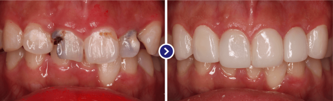 미니쉬 치료 과정