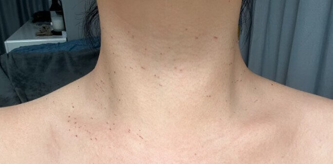 쥐젖 제거 후 상처