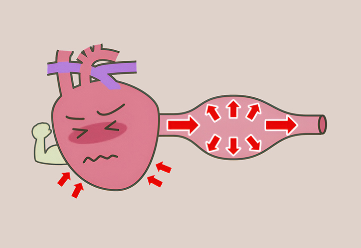 혈압이-높은-혈관