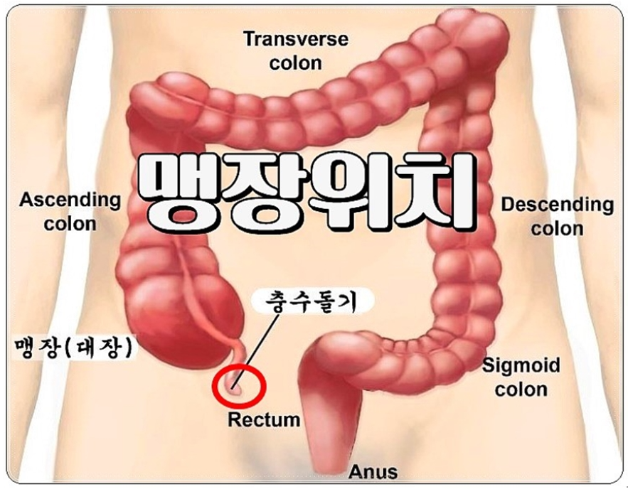 맹장 위치