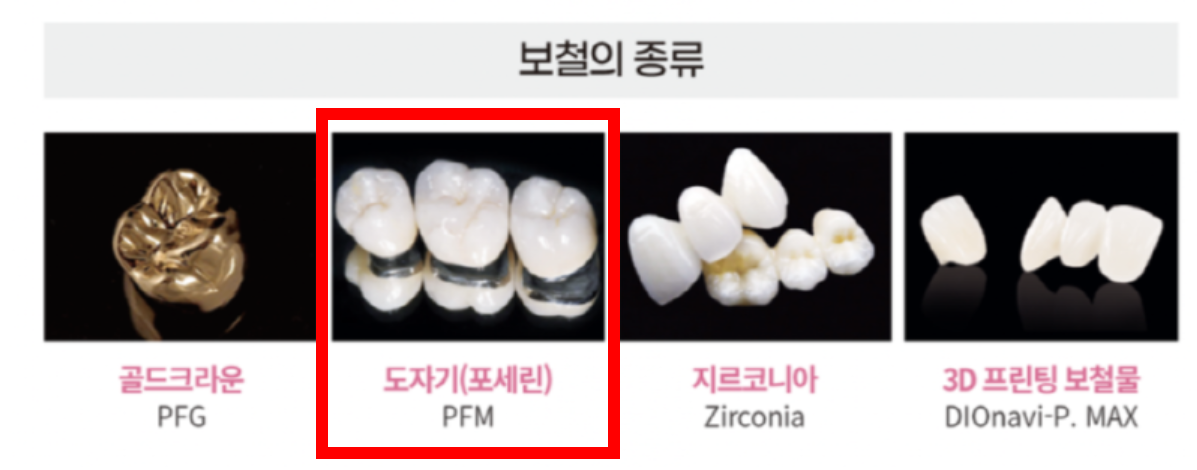 임플란트 의료보험적용대상 보철의 종류