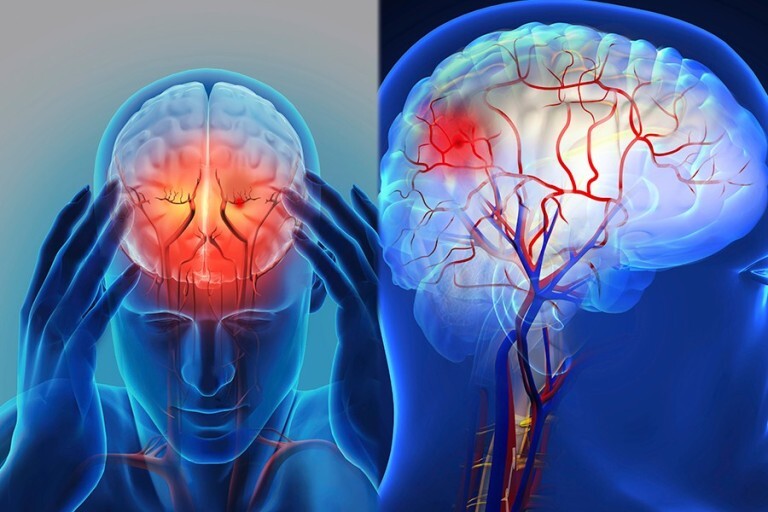 뇌졸증 걸리지 않는 생활 방법