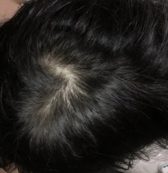 정수리가 아픈 이유와 완화하는 방법_9