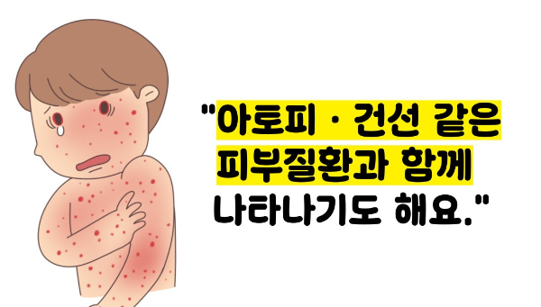모공 각화증 원인 치료